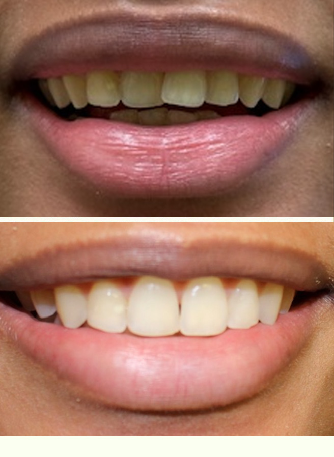 Dentist College Station Before Afters