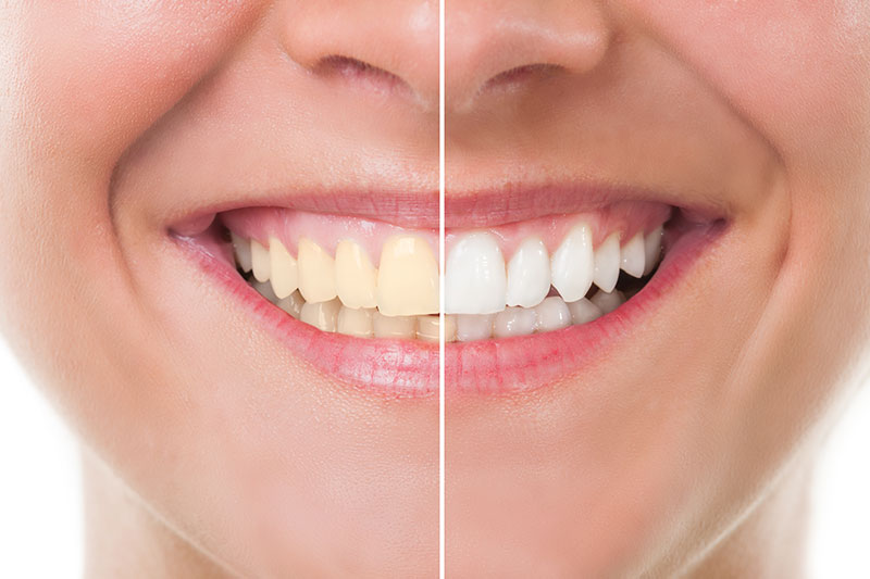 Teeth Whitening in College Station